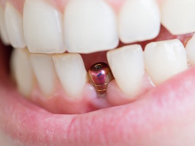 A closeup of a dental implant and its abutment