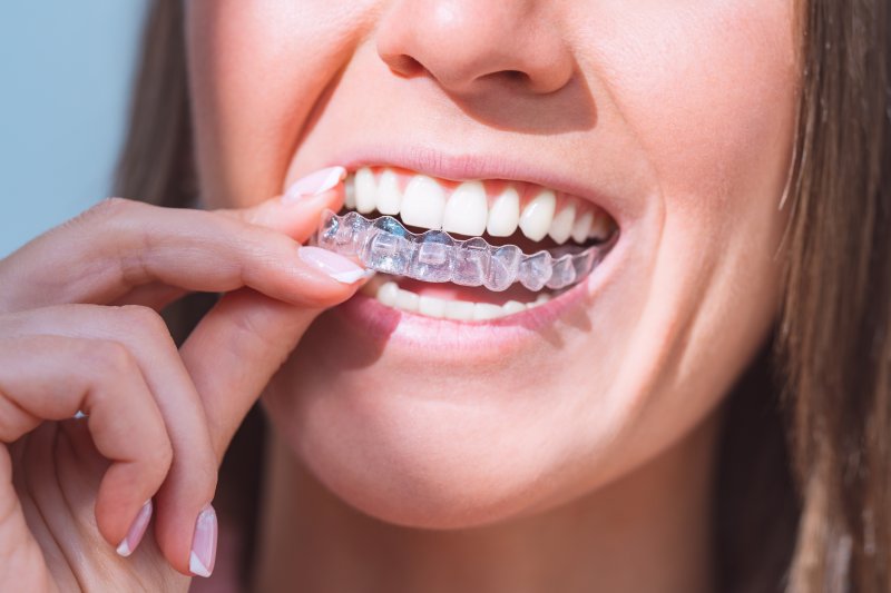 A woman placing clear aligners over her smile