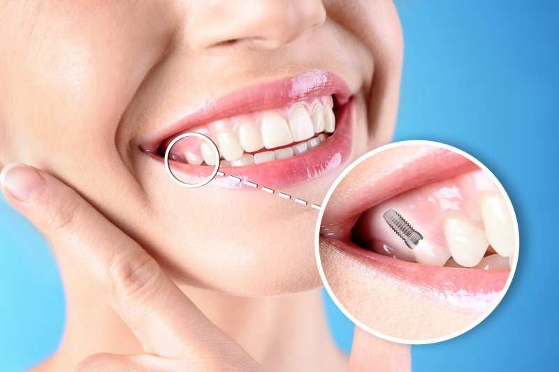 A smiling woman after dental implant installation procedure on blue background